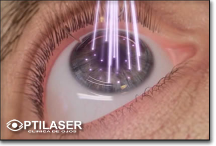 Clinica de ojos Optilaser - Excimer Laser